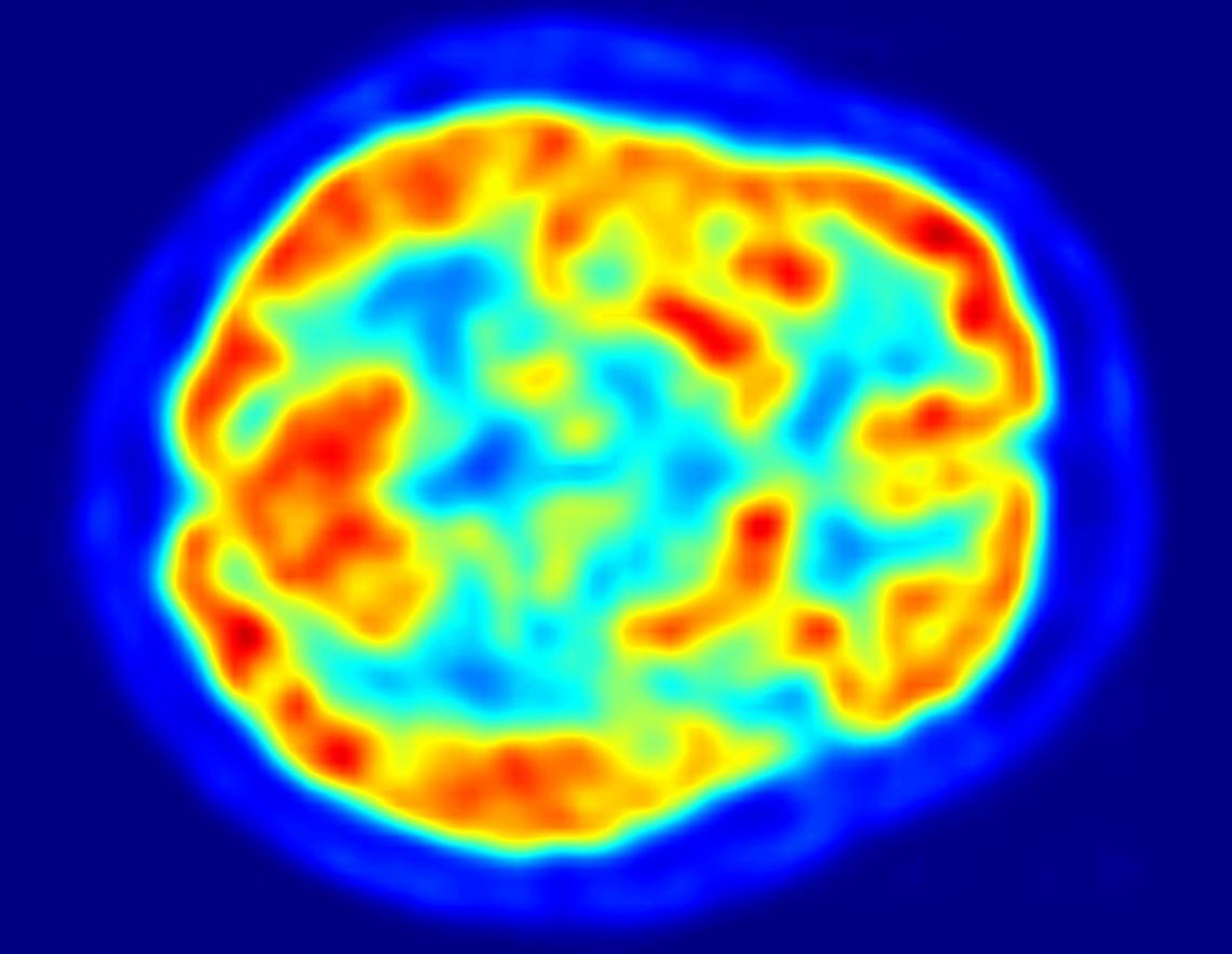 UA researchers studied brain images of 124 cognitively normal, non-diabetic adults with a family history of Alzheimer's disease. 